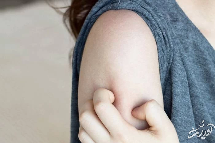 خارش بازو ناشی از تزریق واکسن کرونا خارش بازو